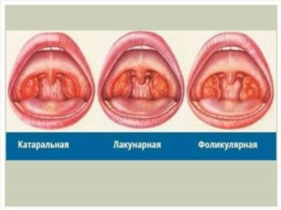 Способы передачи бактериальной ангины: заразен ли пациент