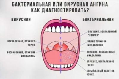 Популярные методы лечения ангины фолликулярной