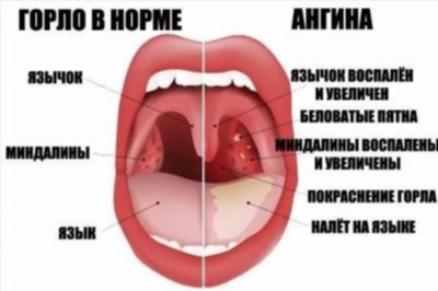 Как правильно лечить ангину фолликулярную?