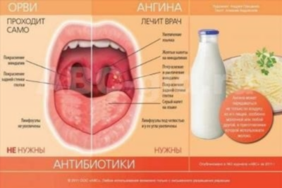 Причины и признаки развития ангины