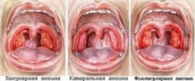 Стандарты лечения ангины