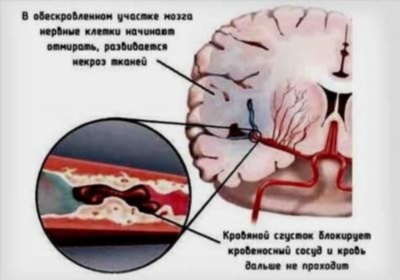 Недостаток кислорода в головном мозге может являться одной из причин возникновения спазма сосудов