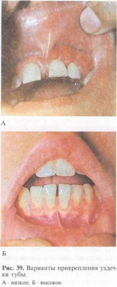 Лечение короткой уздечки губы