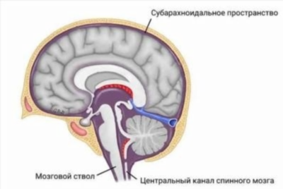 Аномалия Киари: причины, симптомы, диагностика и лечение