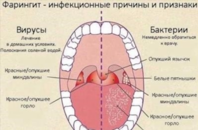 Лечение гнойной ангины антибиотиками у взрослых