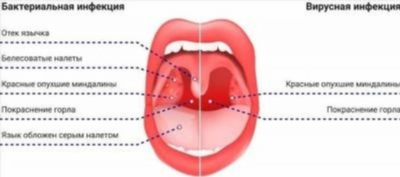 Почему нельзя навсегда избавиться от тонзиллита с помощью антибиотиков