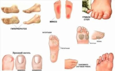 Преимущества антибиотиков при лечении грибка ногтей