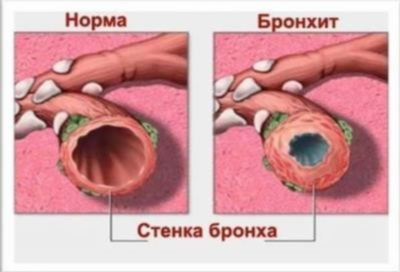 Как правильно выбирать лекарства при цистите?