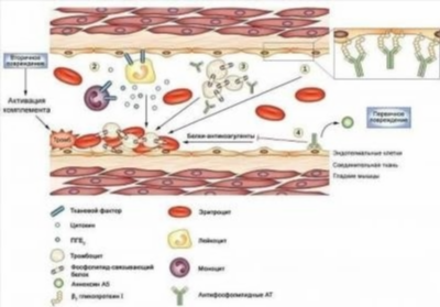 Причины антифосфолипидного синдрома