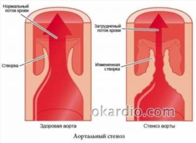 Симптомы аортального стеноза
