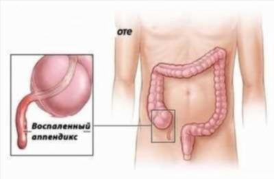 Показания, этапы и техника операции при аппендиците