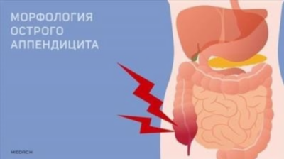 Как происходит диагностика аппендицита в Тбилисской ЦРБ?