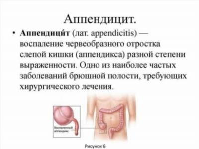 Острый аппендицит: какие симптомы указывают на возможное заболевание