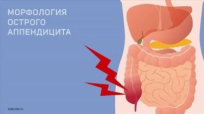 Первые симптомы аппендицита у подростков