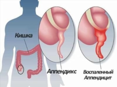 Причины возникновения аппендицита у взрослых