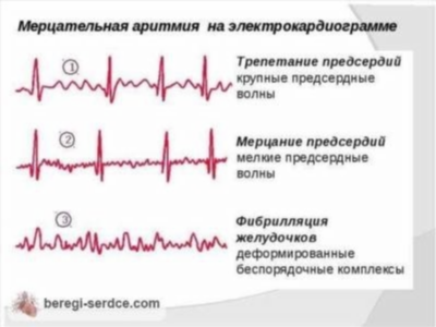 Причины брадикардии: болезни сердца и не только