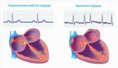 Аритмия сердца: типы, симптомы, диагностика
