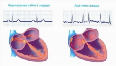 Профилактика нарушений сердечного ритма