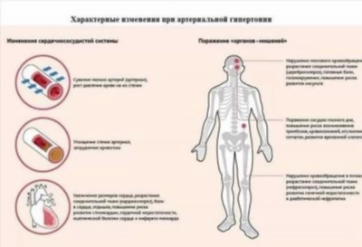 Артериальная гипертензия: основные рекомендации