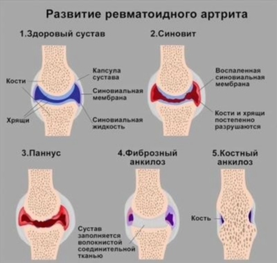 Профилактика артрита ног