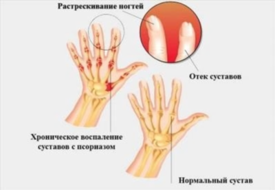 Стадии развития полиартрита и особенности каждой