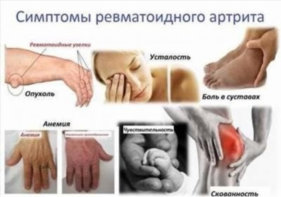 Методы диагностики артрита