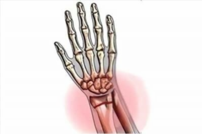 Лечение, причины и симптомы артрита запястья руки