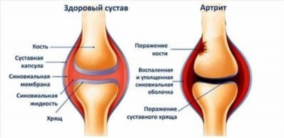 Понятия артроз и остеоартроз