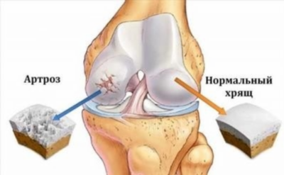 Гонартроз: причины, симптомы, лечение