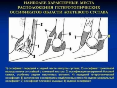 Упражнения для восстановления подвижности локтевого сустава