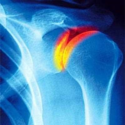 Симптомы артроза плечевого сустава
