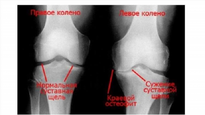 Причины артроза колена