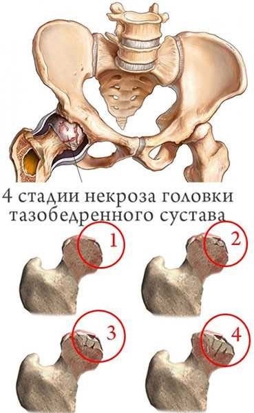 Причины развития асептического некроза головки тазобедренного сустава: