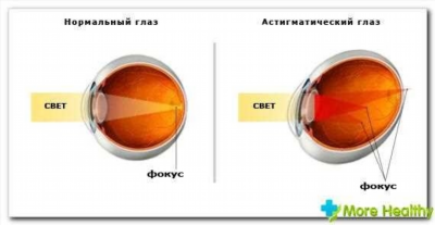 Как видят при астигматизме