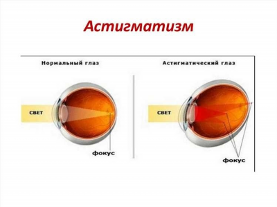 Методы диагностики астигматизма