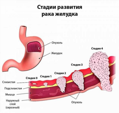 Асцит - развитие недуга, причины и симптомы, лечение патологии