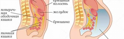 Причины асцита и его связь с другими заболеваниями