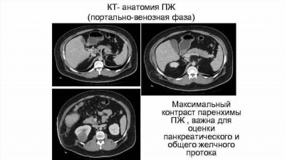 Виды рака, сопровождающиеся асцитом