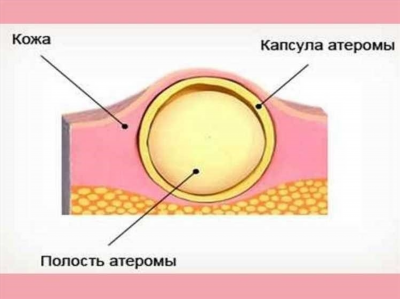 Как лечить атерому: наиболее эффективные способы