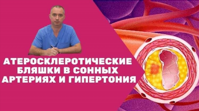 Атеросклеротические стенозы сонных артерий - причина мозгового инсульта