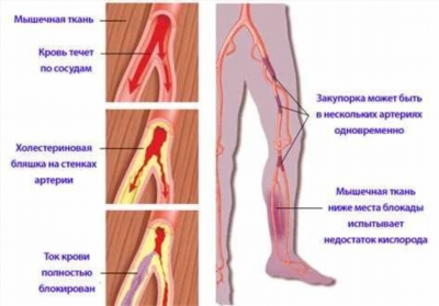 Симптомы атеросклероза нижних конечностей