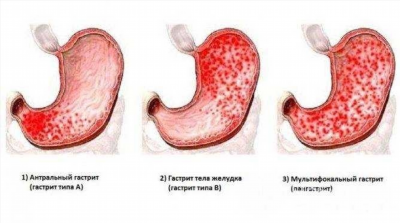 Диета и схемы лечения атрофического гастрита