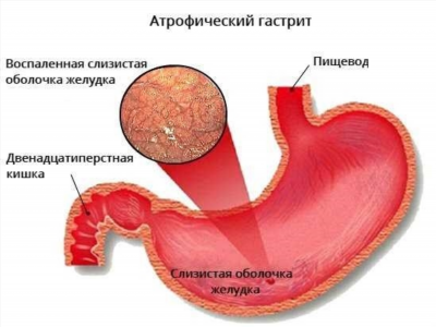 Осложнения атрофического кольпита