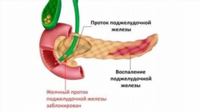 Аутоиммунное панкреатическое поражение поджелудочной железы