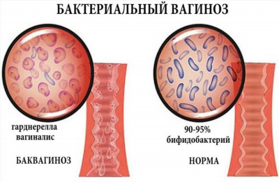 Почему развивается менингит у детей?