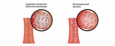 Причины возникновения бактериального вагиноза