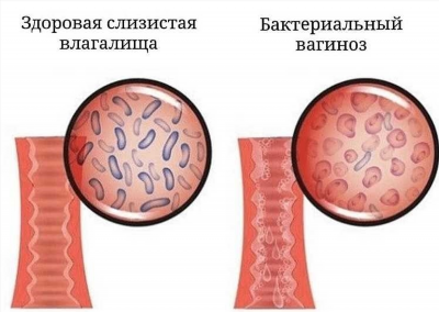 Симптомы кандидоза и вагиноза