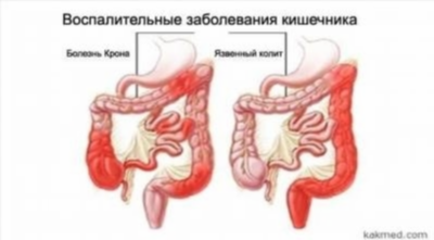 Синдром раздраженного кишечника: симптомы и эффективное лечение