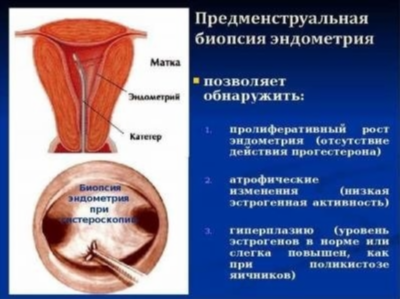 FAQ о сложной гиперплазии эндометрия