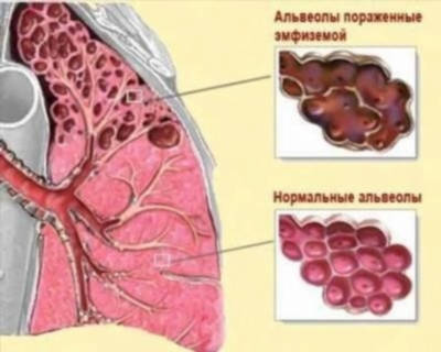 Симптомы наружного отита